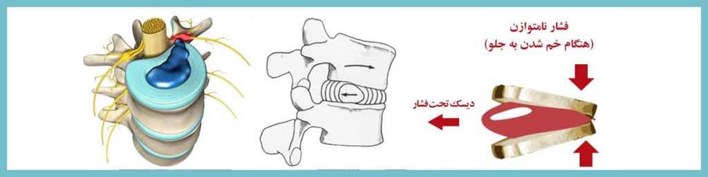 بیرون زدگی دیسک بین مهره ای در اثر نشستن نادرست