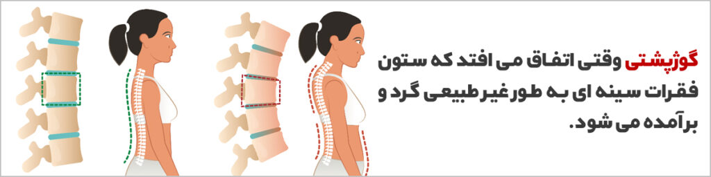 گوژپشت